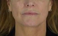 Facelift before and after - after