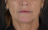 Facelift before and after - before