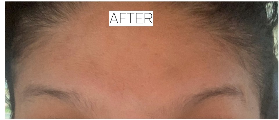 Breast Augmentation and Mastopexy before and after - after
