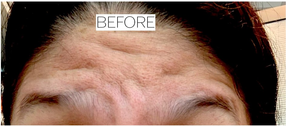 Botox before and after - before