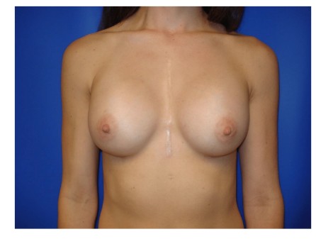 Breast Augmentation before and after - after