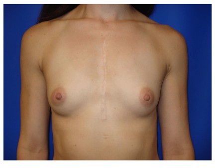 Breast Augmentation before and after - before