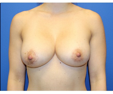 Breast Augmentation before and after - after