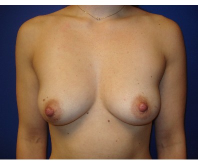 Breast Augmentation before and after - before