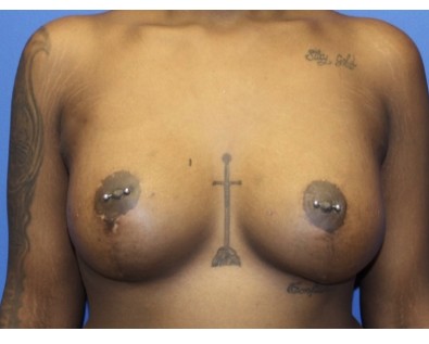 Breast Augmentation with Mastopexy before and after - after