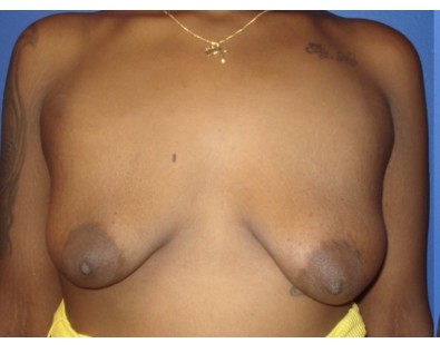 Breast Augmentation with Mastopexy before and after - before