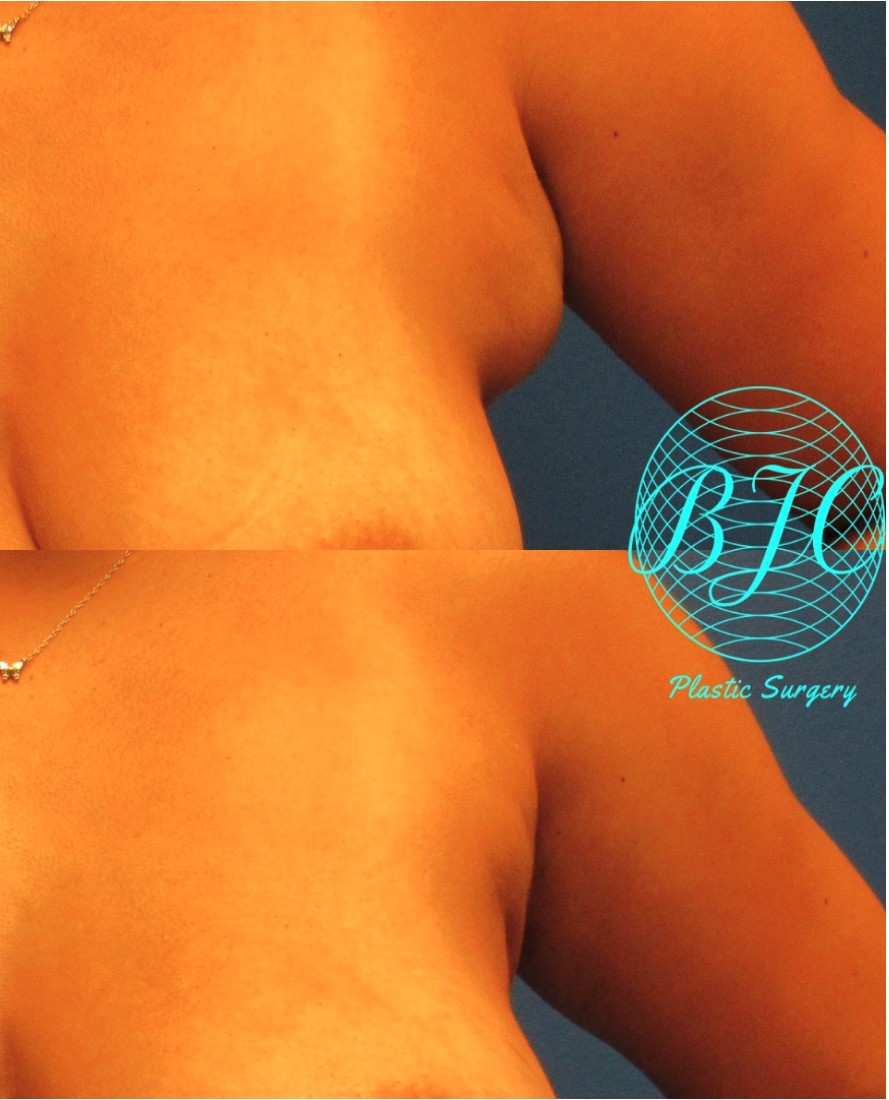Breast Reconstruction before and after - after