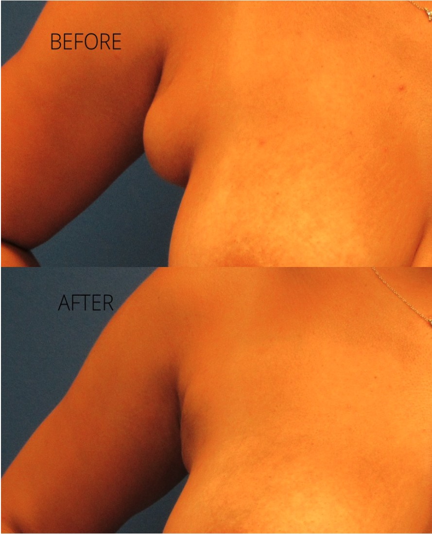 Breast Reconstruction before and after - before