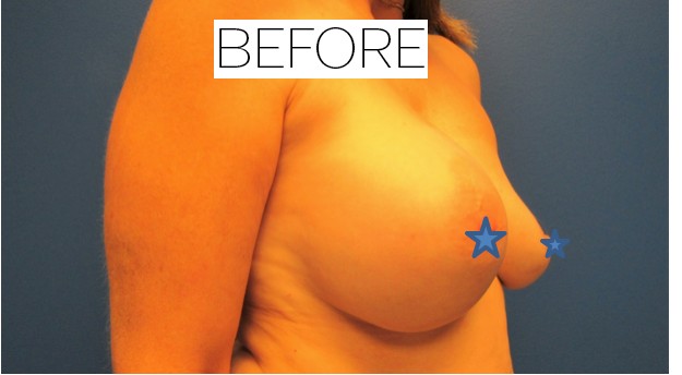 Breast Augmentation and Breast Lift before and after - before