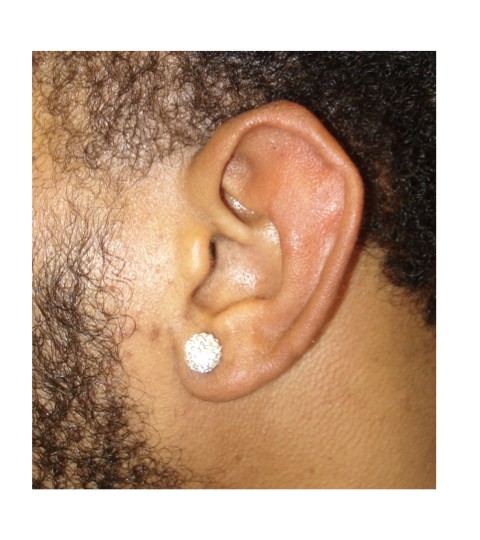 Ear Keloid Excision before and after - after