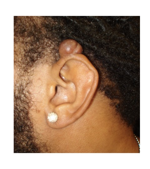 Ear Keloid Excision before and after - before
