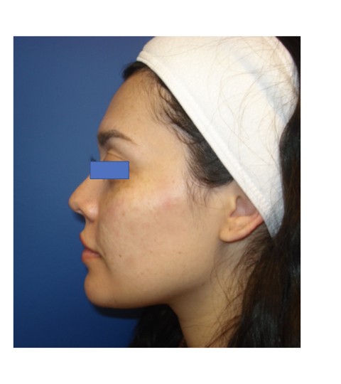 Cheek Augmentation before and after - after