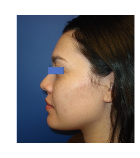 Cheek Augmentation before and after - before