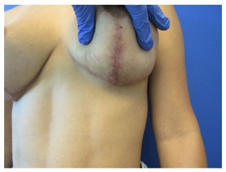Botox before and after - after