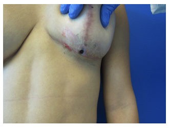Botox before and after - before