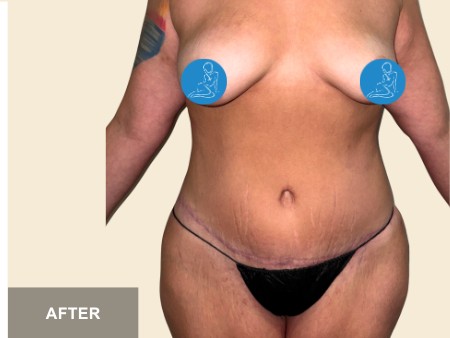 Tummy Tuck before and after - after