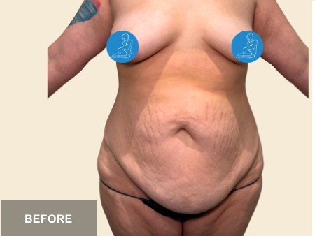 Tummy Tuck before and after - before