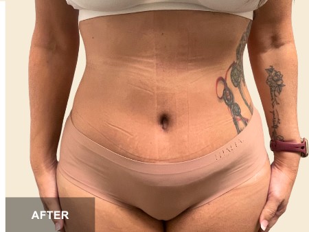 Tummy Tuck before and after - after