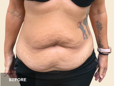 Tummy Tuck before and after - before