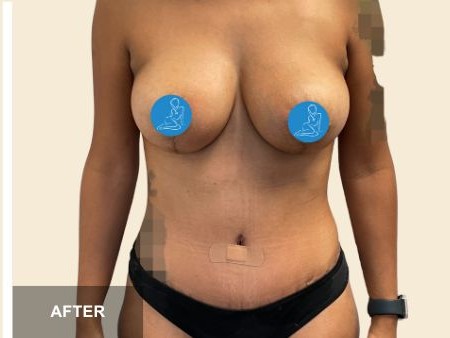 Tummy Tuck before and after - after