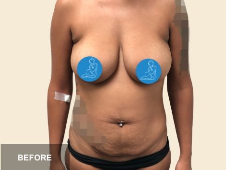 Tummy Tuck before and after - before