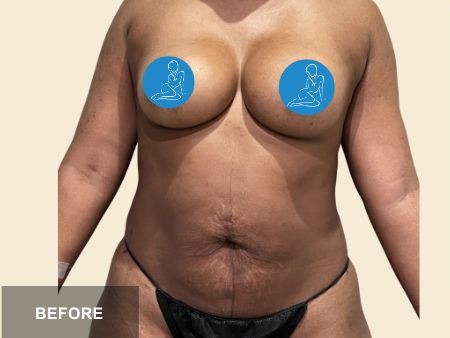 Tummy Tuck before and after - before