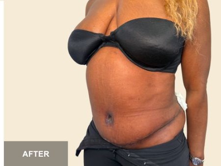 Tummy Tuck before and after - after