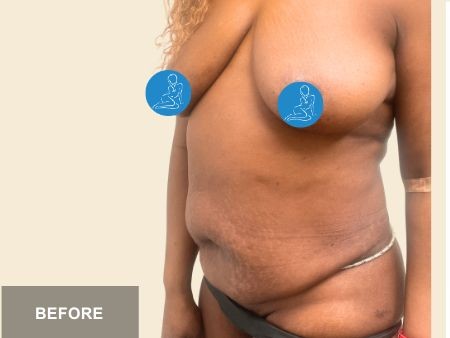 Tummy Tuck before and after - before