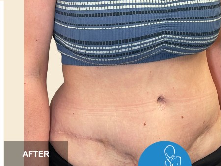 Tummy Tuck before and after - after