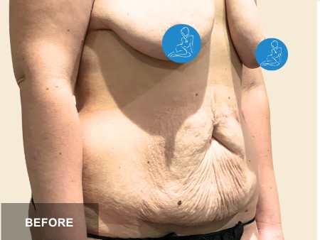 Tummy Tuck before and after - before