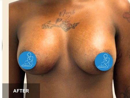 Breast Augmentation before and after - after