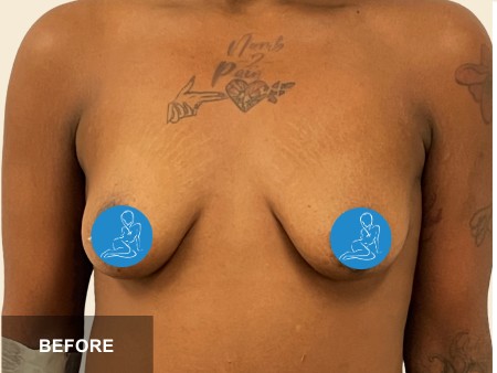 Breast Augmentation before and after - before
