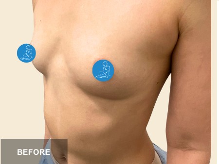 Breast Augmentation before and after - before
