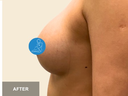 Breast Augmentation before and after - after