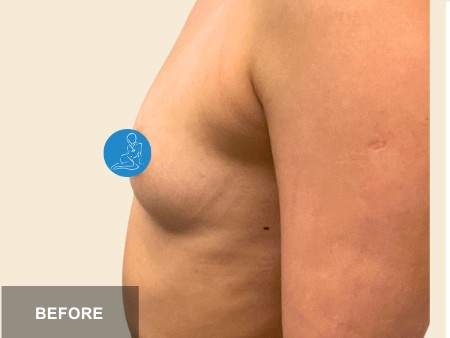 Breast Augmentation before and after - before