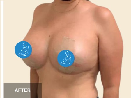 Breast Augmentation before and after - after