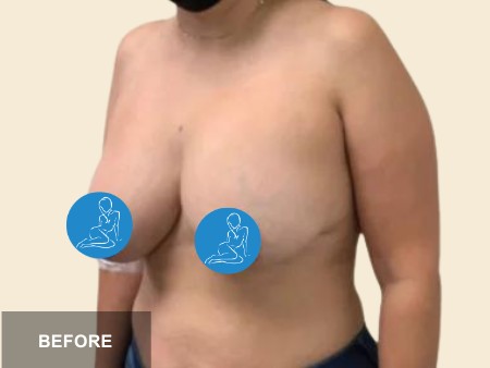 Breast Augmentation before and after - before
