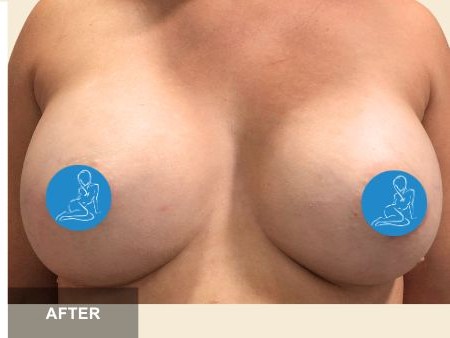 Breast Augmentation before and after - after