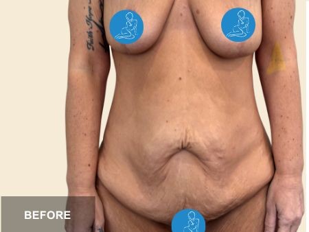 Tummy Tuck before and after - before