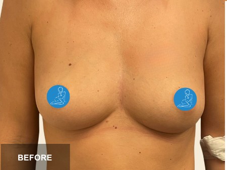 Breast Augmentation before and after - before