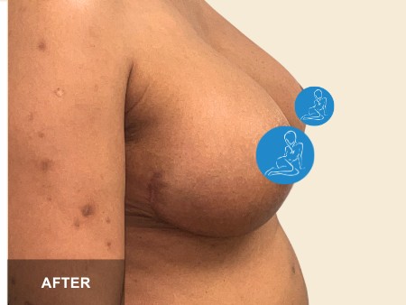 Breast Lift before and after - after