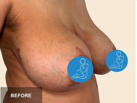 Breast Lift before and after - before