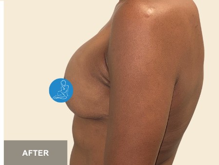 Breast Lift before and after - after