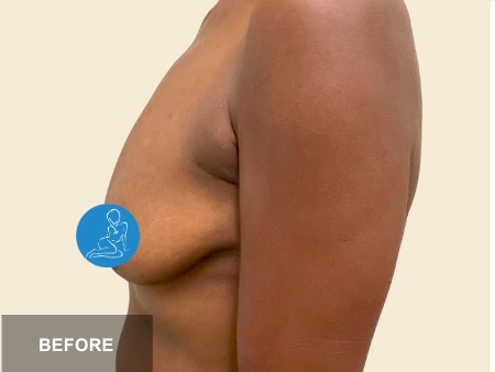 Breast Lift before and after - before