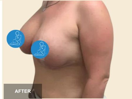 Breast Lift before and after - after