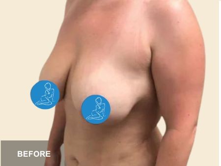 Breast Lift before and after - before