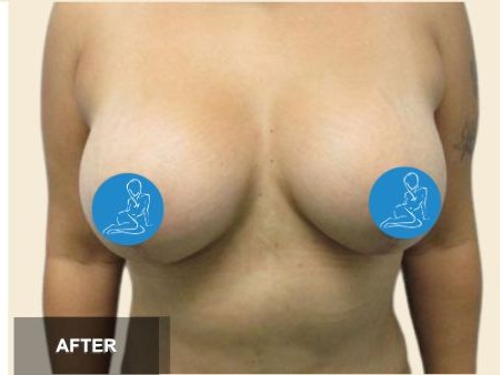 Breast Lift before and after - after