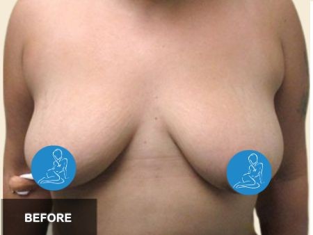 Breast Lift before and after - before