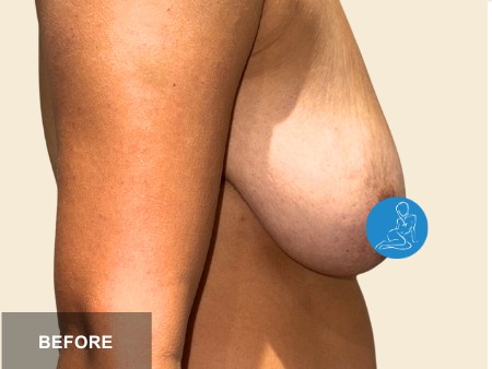 Breast Lift before and after - before