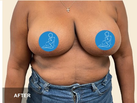 Breast Reduction before and after - after
